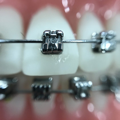 Orthodontics - Braces, Invisalign & Myobraces