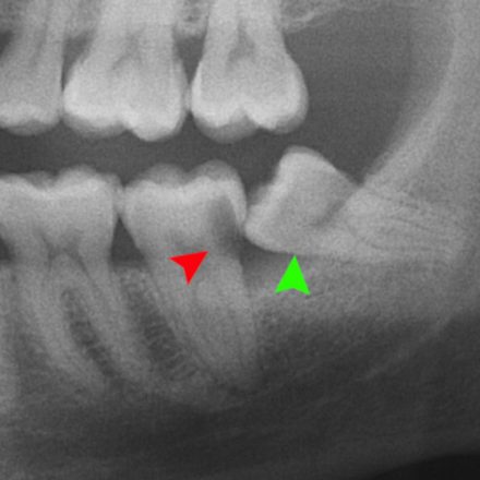 Wisdom Teeth